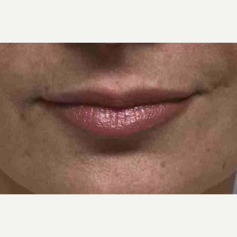 Female treated with Juvederm for Lip Augmentation after 3169137