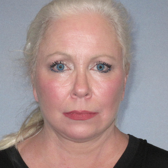55-64 year old woman treated with Facelift after 3108698