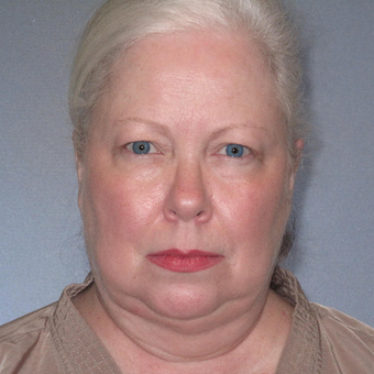 55-64 year old woman treated with Facelift before 3108698