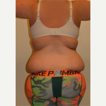 25-34 year old woman treated with Liposuction before 3658463