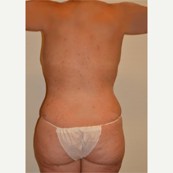 25-34 year old woman treated with Liposuction after 3658463