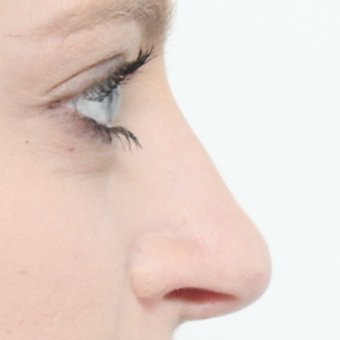 18-24 year old woman treated with Rhinoplasty after 3566047
