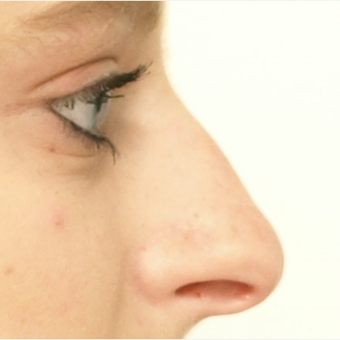 18-24 year old woman treated with Rhinoplasty before 3566047