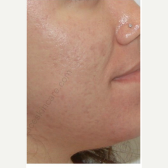 18-24 year old woman treated with Isolaz after 3300492