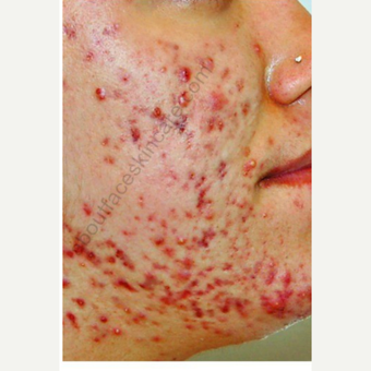 18-24 year old woman treated with Isolaz before 3300492