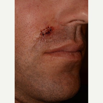 Removal of squamous cell carcinoma from the face of a 34yo man before 1549591