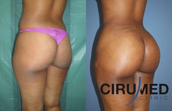 Fat transfer buttock augmentation (Brazilian butt lift) 1125120