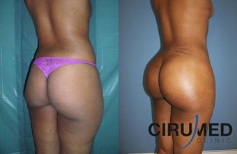 Fat transfer buttock augmentation (Brazilian butt lift) after 1125120
