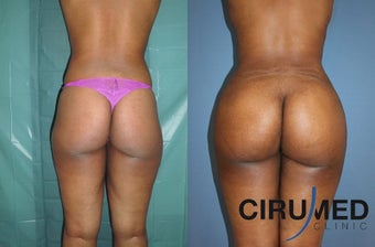 Fat transfer buttock augmentation (Brazilian butt lift) before 1125120