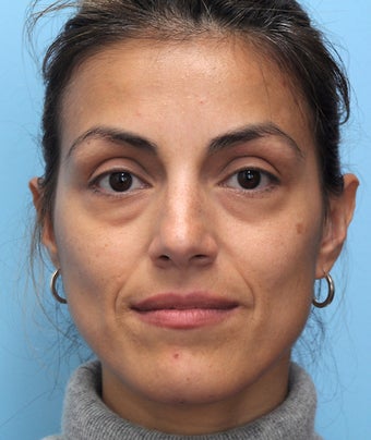 Cheek Dermafiller, Under Eye Dermafiller, Face Dermafiller before 455491