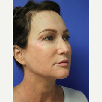 45-54 year old woman treated with Facelift Revision after 3405342