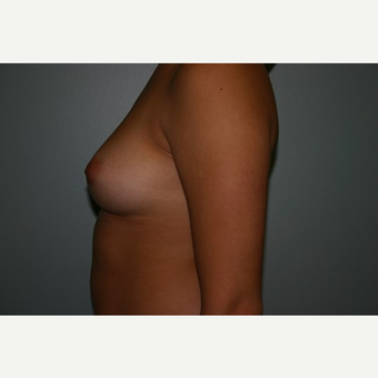 23 year old woman treated with Breast Augmentation before 3444144