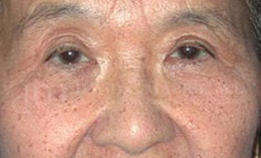 Lateral Browlift & Upper Lid Blepharoplasty 104593