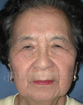 Lateral Browlift & Upper Lid Blepharoplasty before 104593