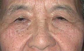 Lateral Browlift & Upper Lid Blepharoplasty 104593