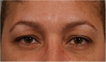 44 Year olf female with sagging of her eye brows and upper eye lids. She doesn't want surgery before 766000