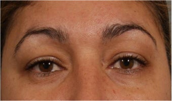 44 Year olf female with sagging of her eye brows and upper eye lids. She doesn't want surgery after 766000