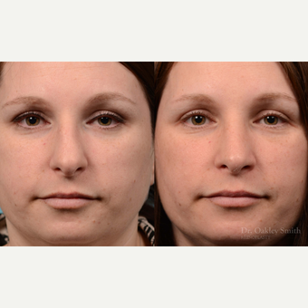 25-34 year old woman treated with Rhinoplasty before 3821376