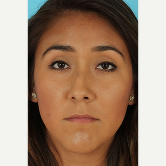 25-34 year old woman treated with Rhinoplasty before 3690867