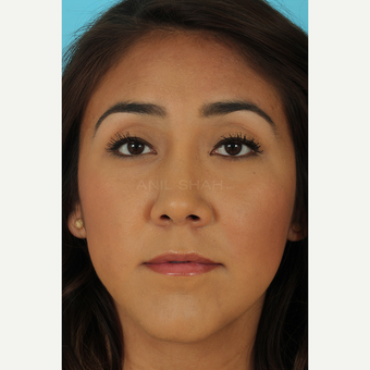 25-34 year old woman treated with Rhinoplasty after 3690867