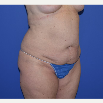 35-44 year old woman treated with No-Drain Tummy Tuck before 3649511