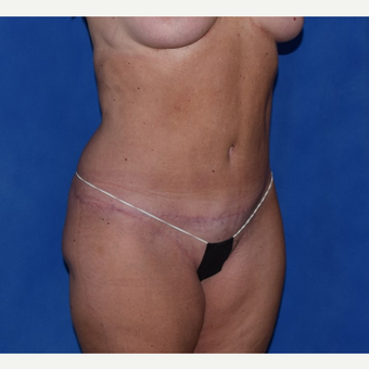 35-44 year old woman treated with No-Drain Tummy Tuck after 3649511