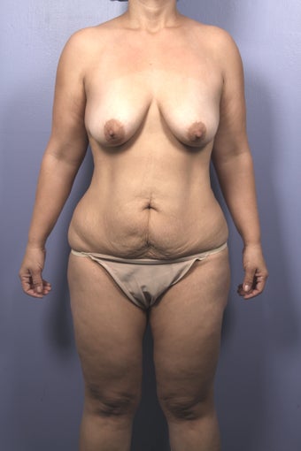 40 yr old Mommy Makeover before 1099785