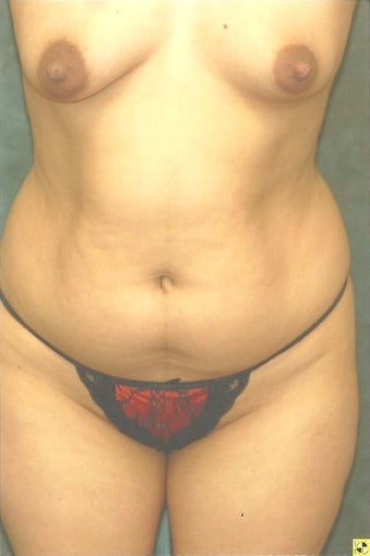 30 year old Mommy Makeover surgery before 1488322