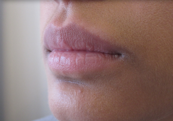 Lip Augmentation before 1305535