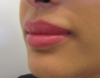 Lip Augmentation after 1305535