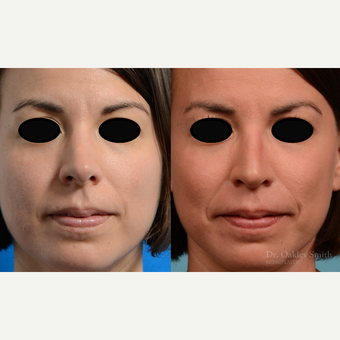 35-44 year old woman treated with Rhinoplasty before 3821361