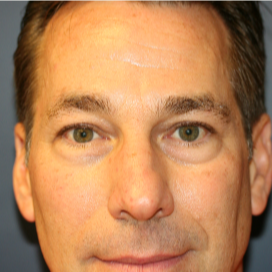 45-54 year old man treated with Eye Bags Treatment before 3554010