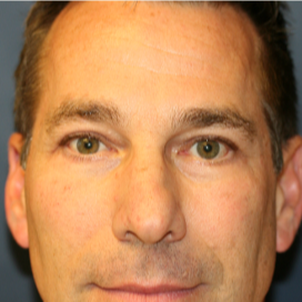 45-54 year old man treated with Eye Bags Treatment after 3554010