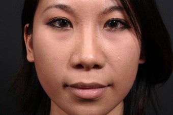 This young lady underwent alar base (nostril) reduction under local anesthesia before 748989