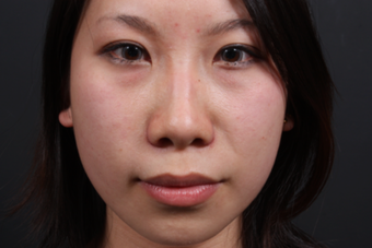 This young lady underwent alar base (nostril) reduction under local anesthesia after 748989