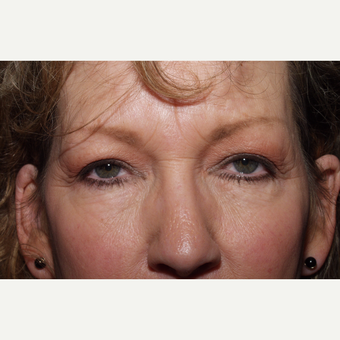55-64 year old woman treated with Brow Lift before 3481322