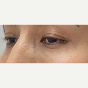 25-34 year old woman treated with Juvederm 1874282