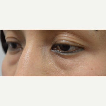 25-34 year old woman treated with Juvederm 1874282