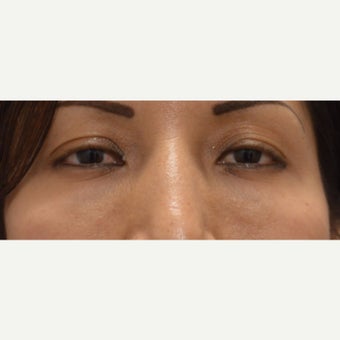 25-34 year old woman treated with Juvederm after 1874282