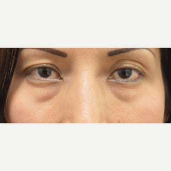 25-34 year old woman treated with Juvederm before 1874282