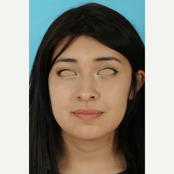 25-34 year old woman treated with Rhinoplasty before 3691290