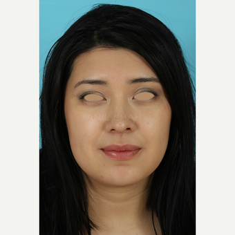 25-34 year old woman treated with Rhinoplasty after 3691290