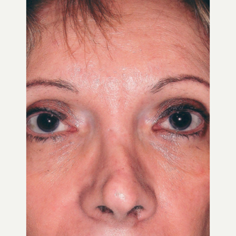 Rhinoplasty before 3814300