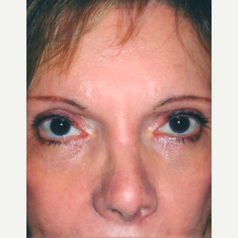 Rhinoplasty after 3814300