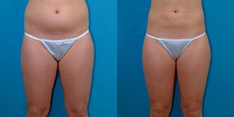 21-year-old woman treated with Liposuction. before 3287325