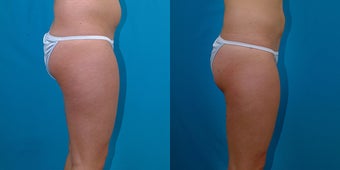 21-year-old woman treated with Liposuction. after 3287325