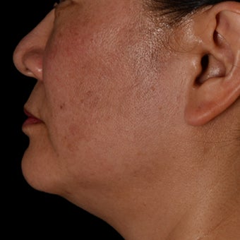 35-44 year old woman treated with Kybella before 2063780