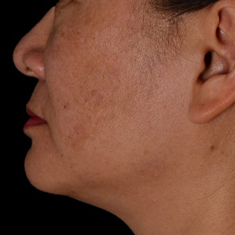 35-44 year old woman treated with Kybella after 2063780
