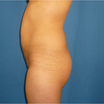 25-34 year old woman treated with Brazilian Butt Lift before 3002351