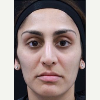32 year old female treated with Botox after 3418019